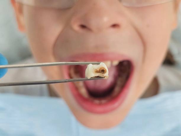 Best Emergency Broken Tooth Repair in El Paso De Robles, CA